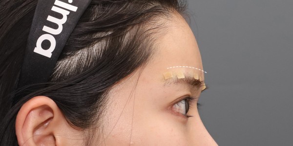 After · Forehead thread lift