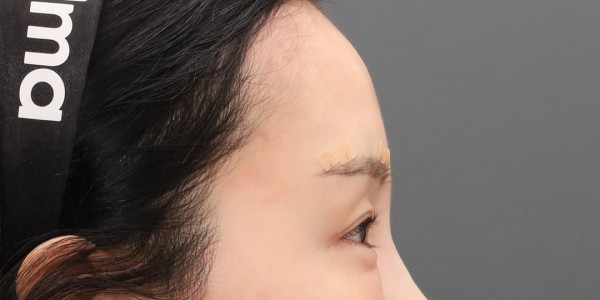 After · Forehead thread lift