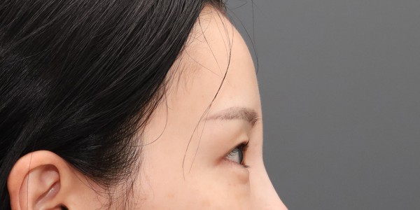Before · Forehead thread lift