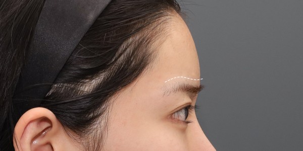 Before · Forehead thread lift