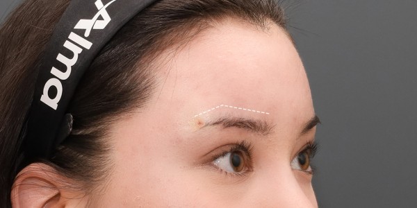 After · Forehead thread lift