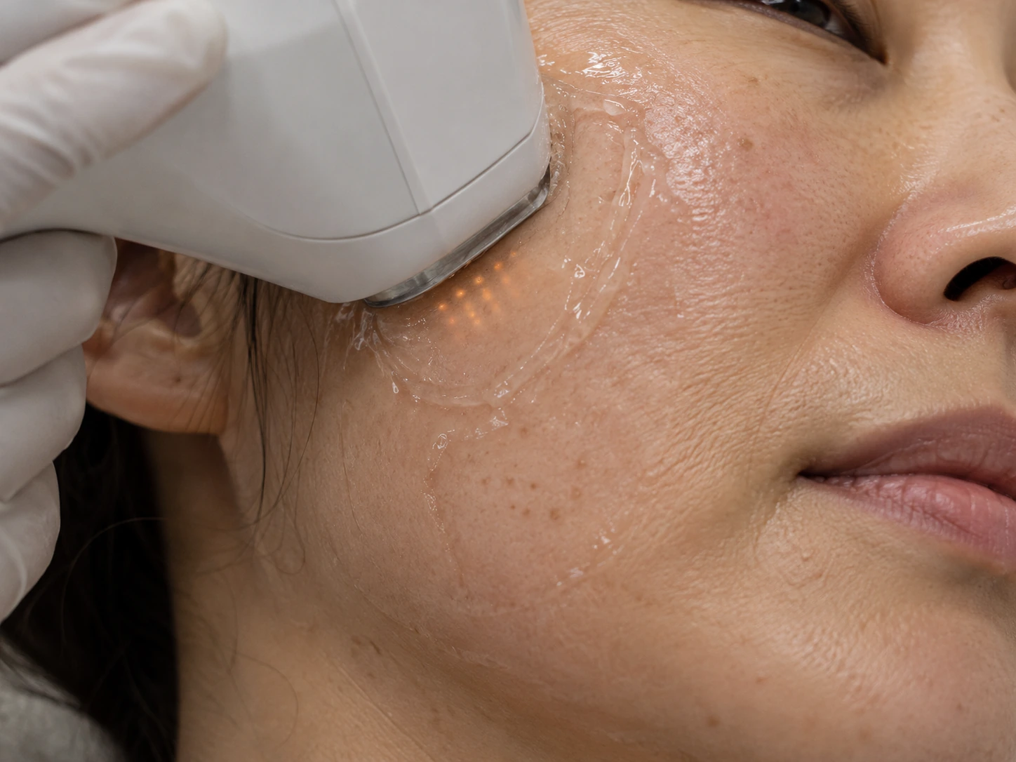 Microfocused ultrasound contact context