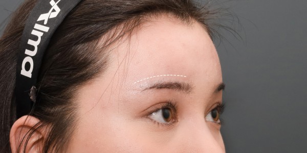 Before · Forehead thread lift